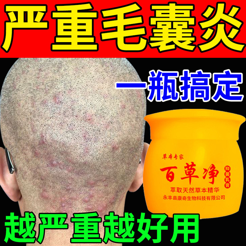 Scalp folliculitis special medicine itchy head with pimples acne pustules red and swollen private parts acne ointment