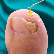 Buy 2 and get 1 free. A drop of potassium can turn bad nails into good ones. Ajonychijing. Enjoy a life of good nails (refundable if not clean).