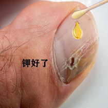 Hot-selling 100000 (Watson’s sold out) Bad nails turn into good nails painless nail removal good nails grow with just one drop