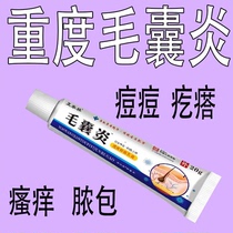 (Folliculitis Cream) scalp face back chest hair follicles acne pustules acne skin itching suppresses bacterial itching