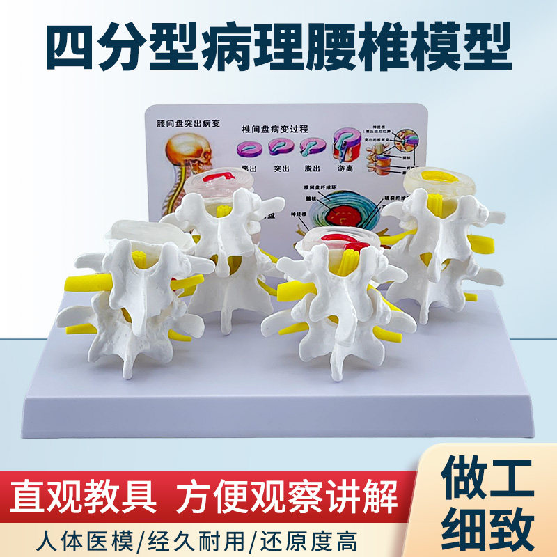 四分型病变腰椎与正常腰椎组合模型 人体骨骼病理骨骼模型