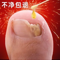 No bag doesnt fix it sooner or later ~ The effect is so good that the bad nail becomes a good one ~ ~ The finger toe repair is getting better