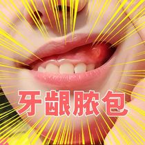 牙龈肿痛瘘管上火牙龈肿包牙痛智齿牙齿疼流脓修复牙根周发炎鼓包