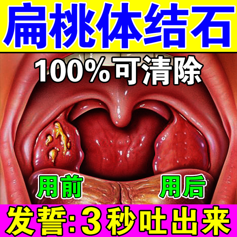 Tonsil stone removal tool Tonsil hypertrophy and swelling to treat bad breath, sore throat, throat inflammation, foreign body sensation