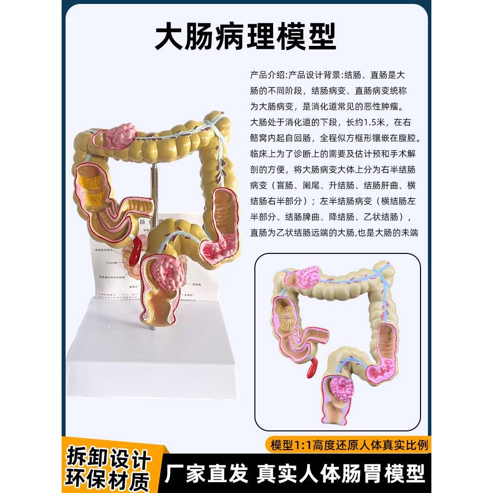 人体肠道胃冠状面结构解剖模型十二指肠消化系统结肠病变疾病模型