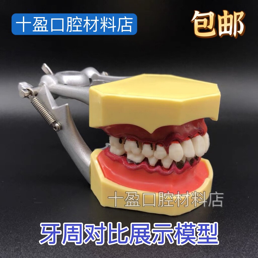 牙科口腔模型牙结石牙周分类牙周对比模型龈上龈下刮治牙结石模型