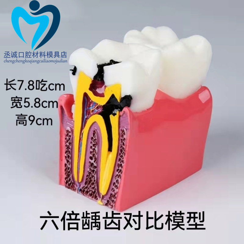牙科 六倍龋齿 六倍龋齿对比模型 解剖放大蛀牙模型 齿科教学模型