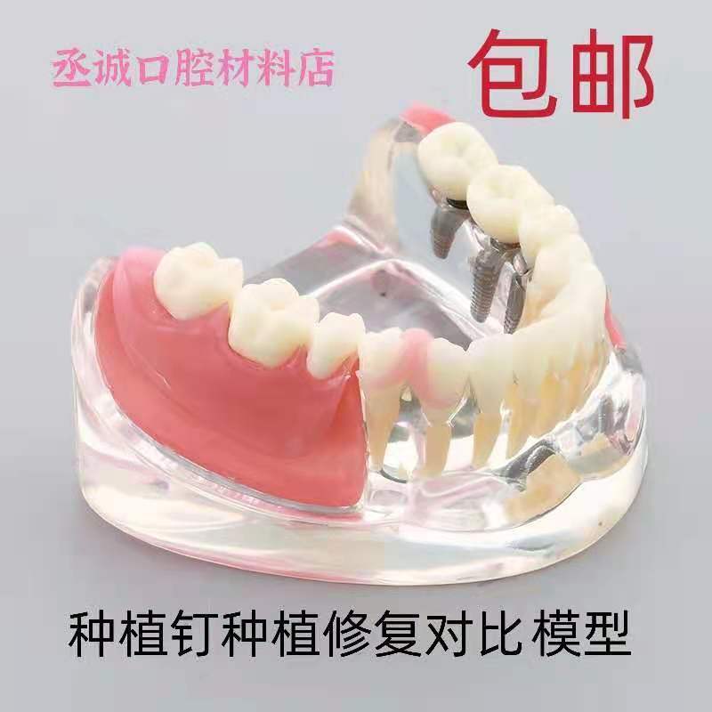 牙科种植修复对比模型 三颗钉 硅胶牙龈 连桥 修复牙齿可拆卸