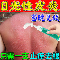 Daylight Dermatitis Skin Sunburn Repair Cream Cured Skin Blisters Red Swollen Hot Pain Desquamation Men And Women Universal