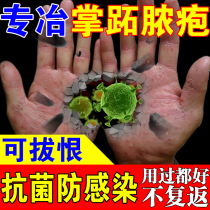 (Special Effects) Metatarsal metatarsal Metatarsal Metatarsal Metatarsal Metatarsal Disease Keratosis of Cephalopal Phalanx of Pussy Hands Foot Abscess Cephalopid Cream