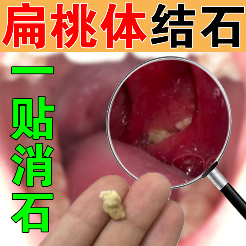 Tonsil stones to remove chronic tonsil inflammation absorber special removal medicine artifact pharynx flat cold compress paste
