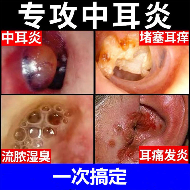 Middle ear stream abscess ear pain red swollen ear block bacteriostatic-Taobao