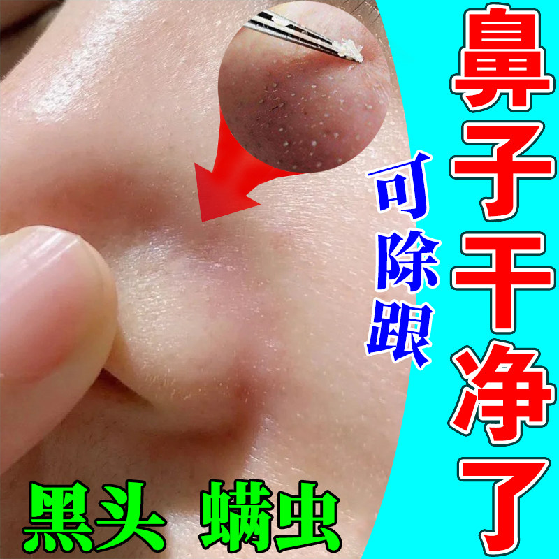 Nose removes mites, washes nose, blackheads on both sides of the nose, oil on the face, large pores, repairs deep acne