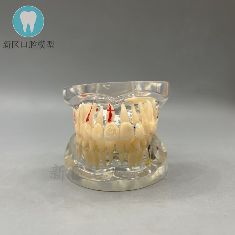 牙科 成人病理模型c4款  带髓腔阻生齿牙模 种植钉龋坏展示 包邮