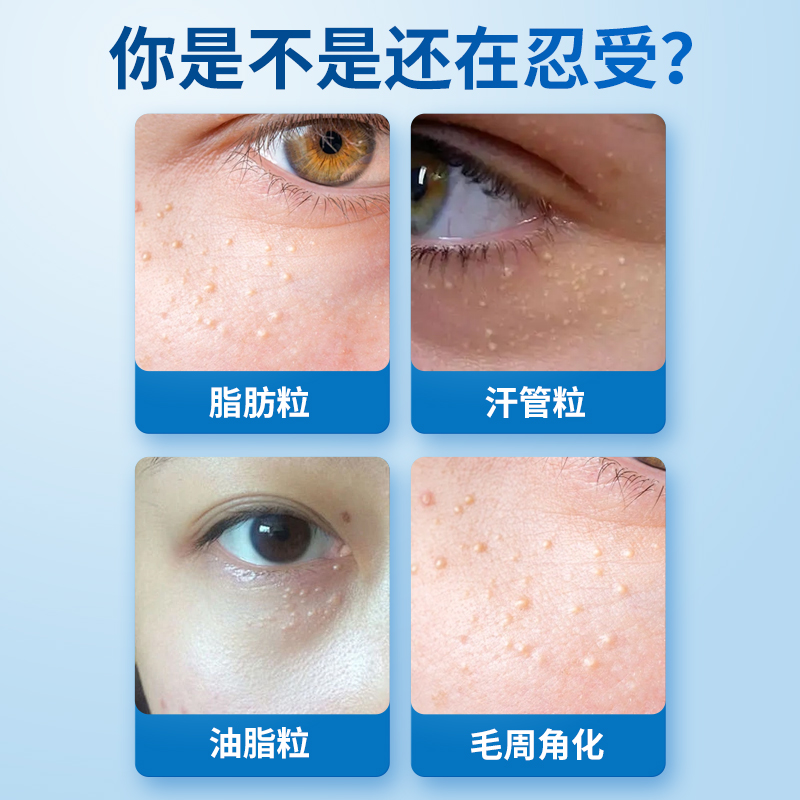 脂肪粒克星：专治眼周烦恼的眼霜膏