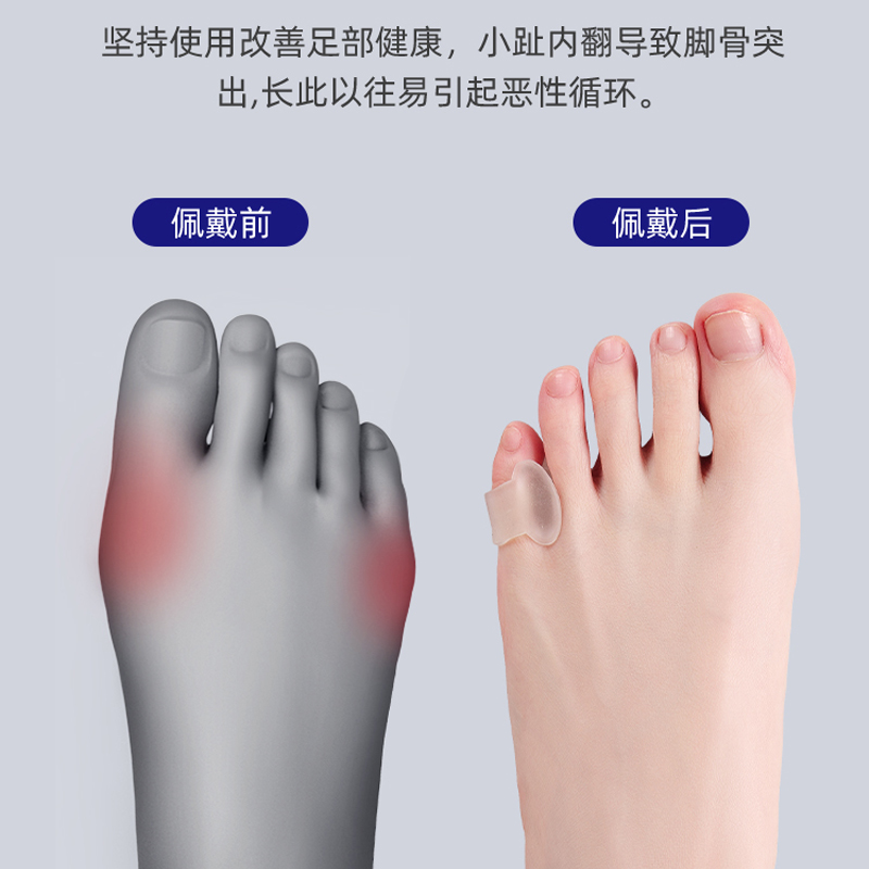 拇指外翻脚趾头保护套：小物件背后的足部关爱