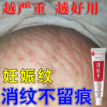 Remove obesity and growth marks remove stretch marks and repair cream. Postpartum elimination lightening and firming belly repair cream.