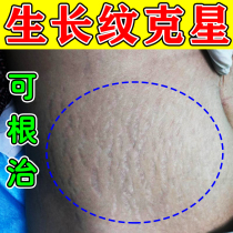 Eliminate growth marks on thighs remove fat lines for students use ointment to remove stretch marks on waist and abdomen tighten belly remove scars