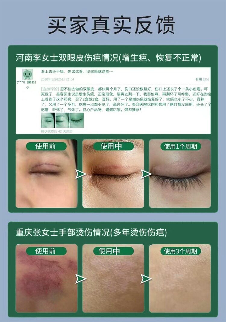 Убрать растяжки массажер 【日本爆款热卖】日系疤痕滚珠修复剖腹产增生凹凸疤痕全身 OTHER