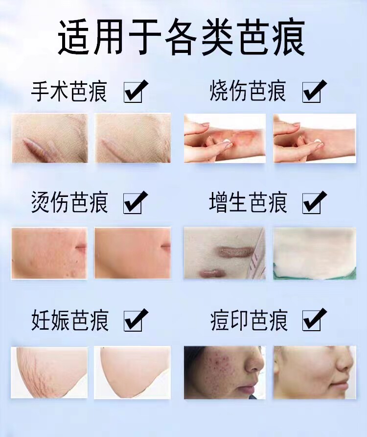 Убрать растяжки массажер 【日本爆款热卖】日系疤痕滚珠修复剖腹产增生凹凸疤痕全身 OTHER