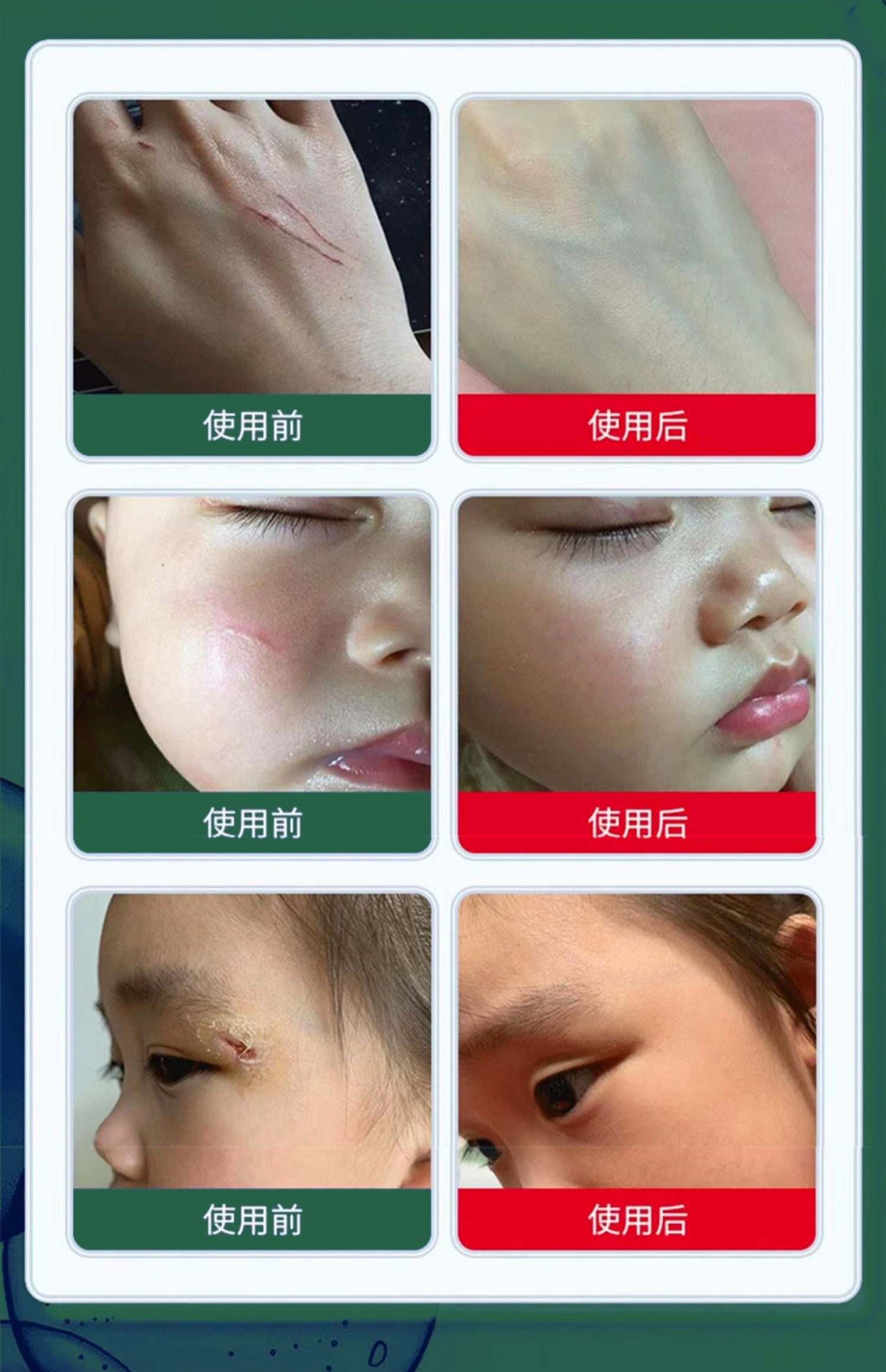 Убрать растяжки массажер 【日本爆款热卖】日系疤痕滚珠修复剖腹产增生凹凸疤痕全身 OTHER