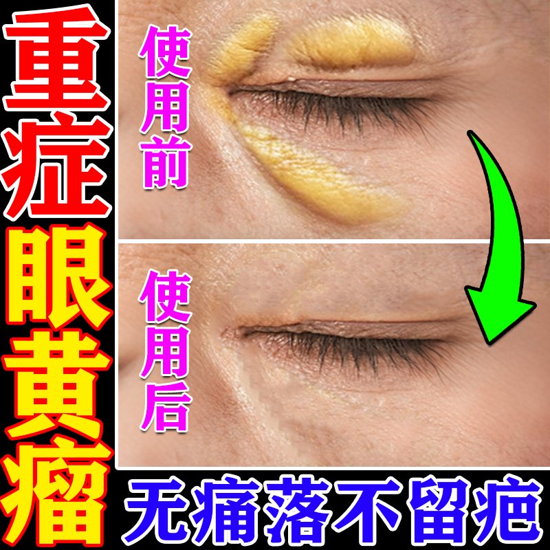 Specialized Ointment for Removing Yellow Spots on Eyelids, Yellow Tumors on Eyelids, Yellow Fat Granules at the Corners of the Eyes, and Medical Removal Ointment for Yellow Flesh Lumps Specialized Ointment for Removing Yellow Spots on Eyelids, Yellow Tumors on Eyelids, Yellow Fat Granules at the Corners of the Eyes, and Medical Removal Ointment for Yellow Flesh Lumps