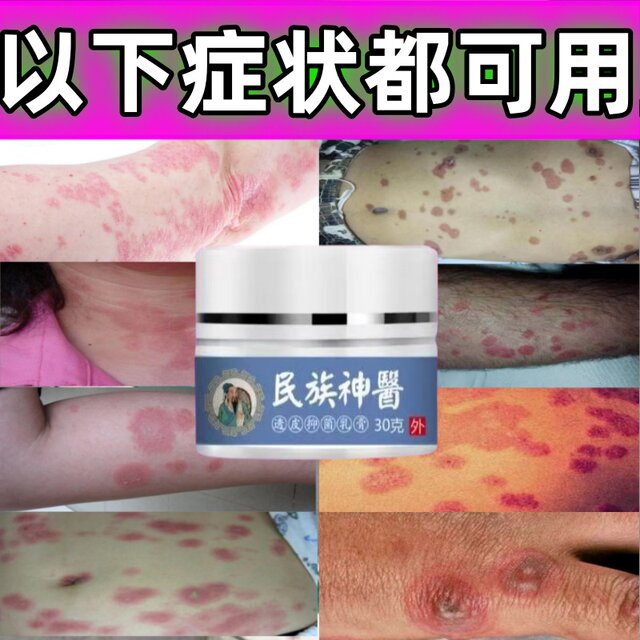 ການປິ່ນປົວຂອງ erythema multiforme, ຢາຂີ້ເຜິ້ງຈີນ, papules, vesicles, pustules, erythema, ການເຊາະເຈື່ອນ, ອາການຄັນ, ເຊື້ອໄວຣັສ, ເຊື້ອແບັກທີເຣັຍ, ແລະເຊື້ອເຫັດ.