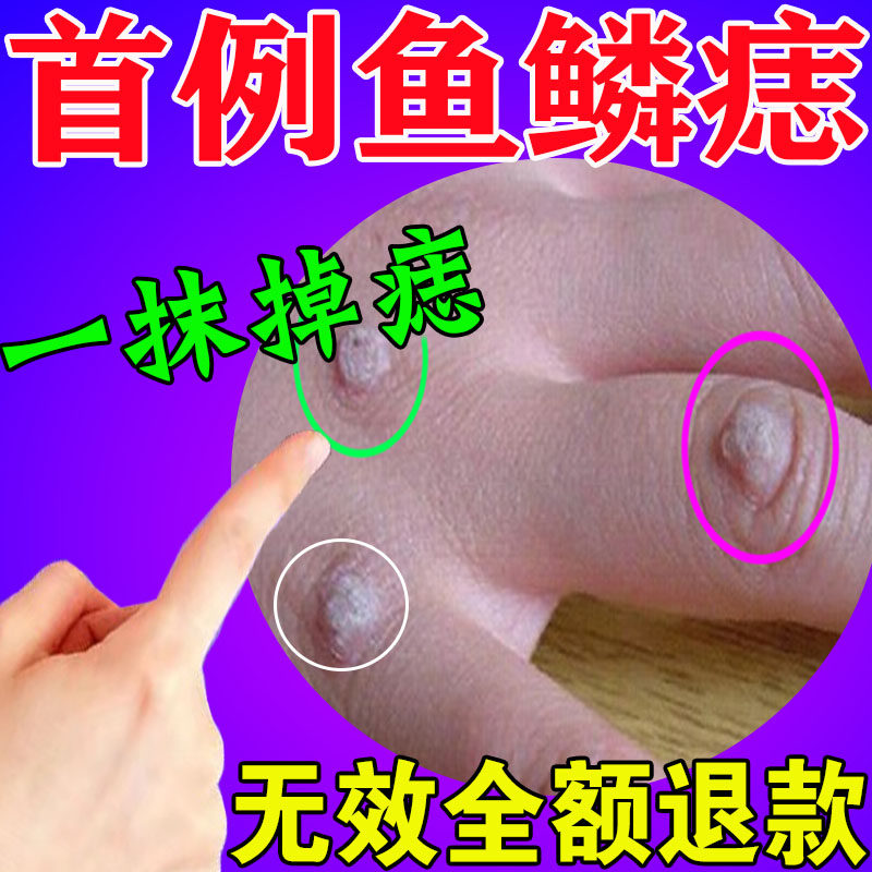 Fish Scale Nevus Ointment Special Medicine Lentils Wart Point Wart finger long monkey meat grain Goose Bumps WART BLOOD Lancet Removal Cream-Taobao