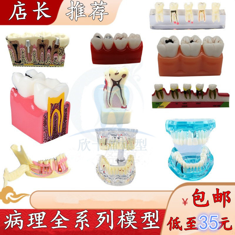 牙科病理模型 龋齿蛀牙 牙周病发展演示水晶成人病理牙齿解剖展示