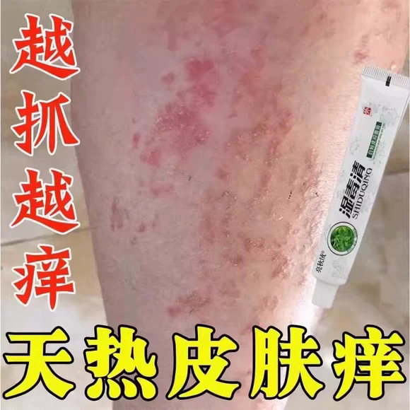 Summer Itchy Legs and Body Rash Relief Cream for Adults - Relieves Sweat, Itchy Skin, Heat Rash, Red Rash, Heat Blisters, and Itching Summer Itchy Legs and Body Rash Relief Cream for Adults - Relieves Sweat, Itchy Skin, Heat Rash, Red Rash, Heat Blisters, and Itching