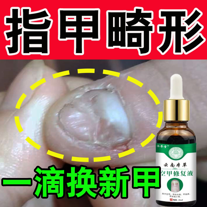 Nail Cap Deformity Repair Growth Solution, Nails with Uneven Surfaces, Pits and Grooves, Nail Recession, Honor