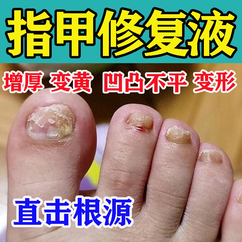 Nail Repair Growth Solution for Yellowing, Thickening, and Graying Toenails; Blackened, Damaged, and Deformed Toenails; Herbal Antibacterial Solution