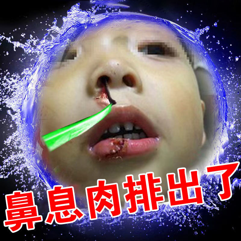 Nasal polyps (automatic fall) nasal nasal and nasal nasal congestion