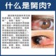 去除眼睛胬肉滴眼液眼角长翼状胬肉有异物感模糊看不清专用眼药水