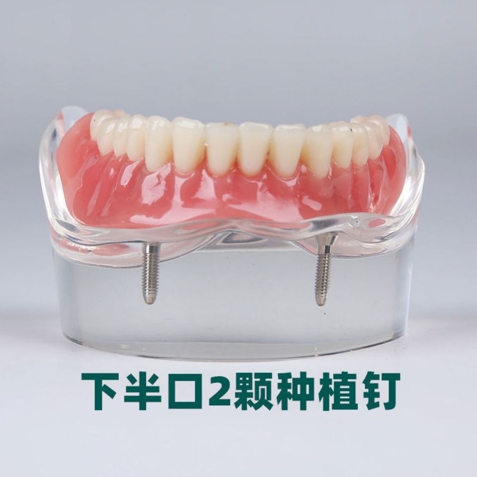 牙科口腔模型 2颗钉4颗钉种植体修复模型上下颌种植修复模型齿科