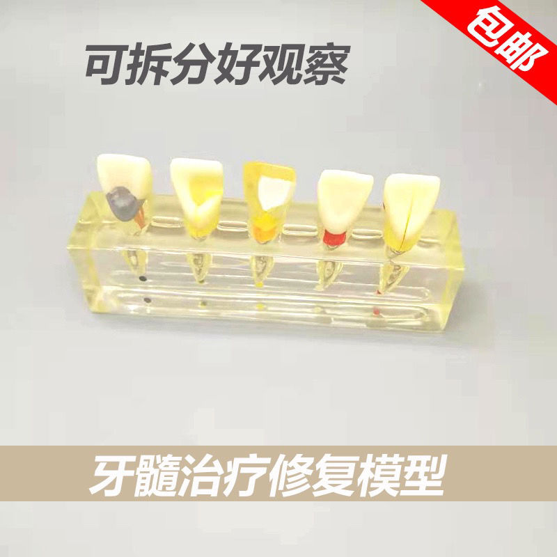 牙科教学模型 牙齿解剖分解 医患沟通牙体牙髓修复 可拆分 包邮