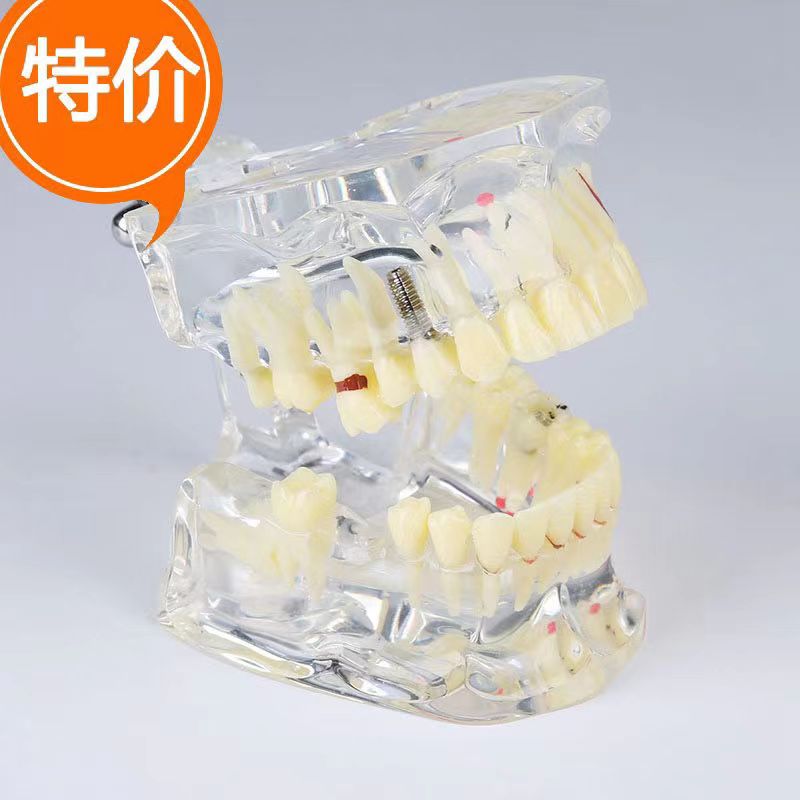 牙科口腔教学模型 成人病理模型 水晶透明综合病沟通 种植钉模型