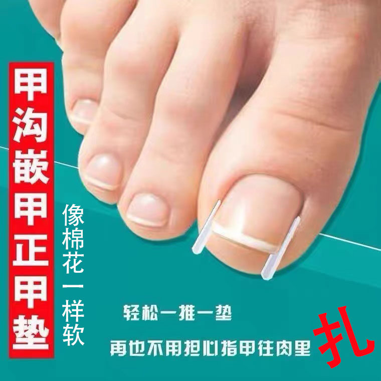甲沟嵌甲矫正器正甲垫填充垫指甲往肉里长隔离垫纠正脚趾甲神器新