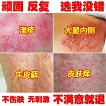 Wet poison clearing fresh cowhide dander for external use under the crotch and on the inner thighs for itchy skin antibacterial Pikang Wang antiseptic and antipruritic cream