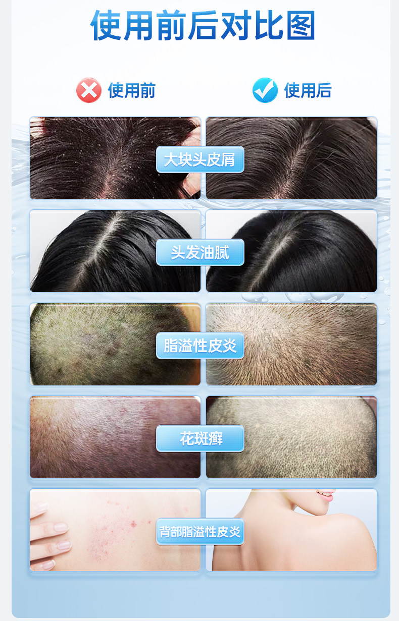999 二硫化硒洗劑 脂漏性皮膚炎 去頭皮屑 毛囊炎洗髮精 止癢 花斑 汗癬 150g*1瓶/盒
