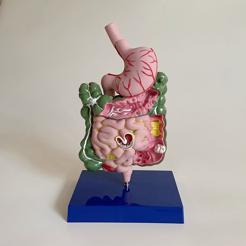胃肠模型 消化系统大肠肛肠科医患痔疮阑尾息肉扭转病理结肠直肠