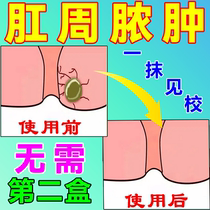Treatment of anal abscess hard block drug special effect anal fistula anal pus extraction toxin in adult fistula