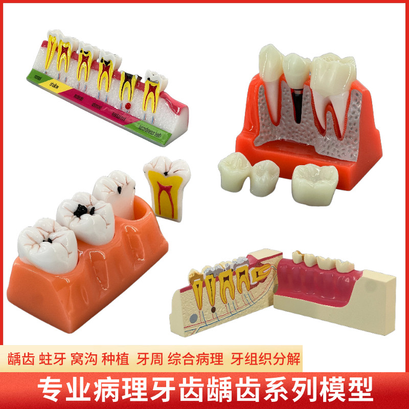牙齿口腔坏变模型龋齿对比4倍龋齿分解牙齿发展演变 蛀牙牙齿模型