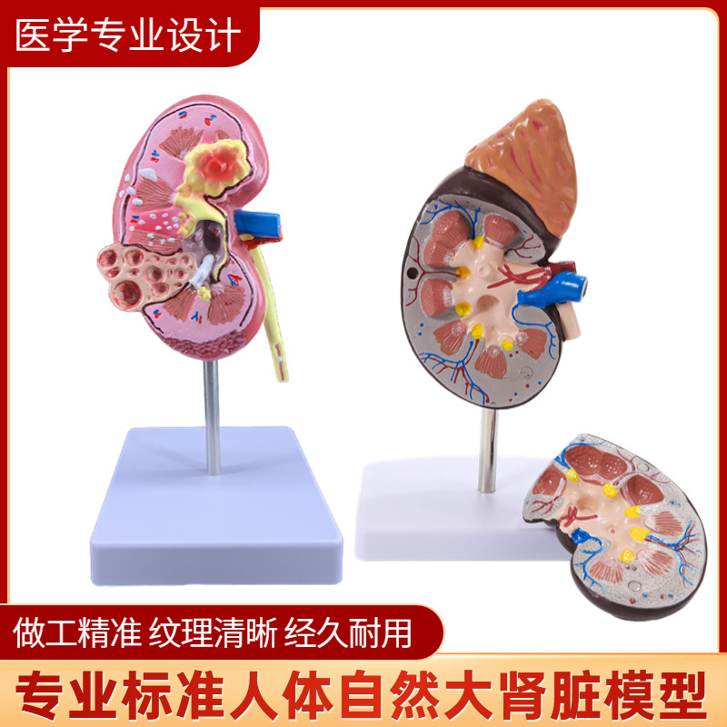 人体肾解剖模型 正常肾部模型,病理肾脏模型专业内脏器官医学教具