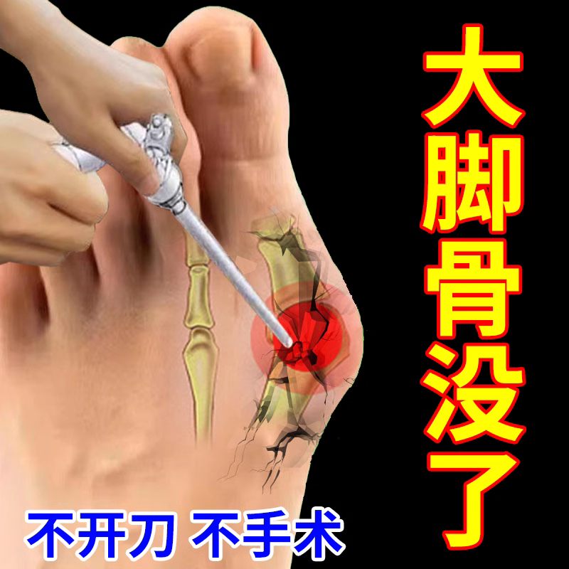 201% works) thumb valgus correction deity special medicine large footed bone valgus thumb valgus overlap sticker-Taobao