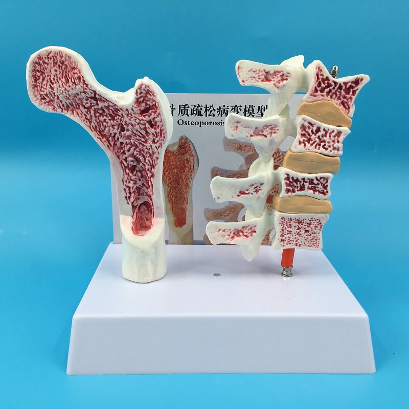 人体股骨骨质疏松解剖模型 腿骨解剖面脊柱切面标本 病变腰椎模