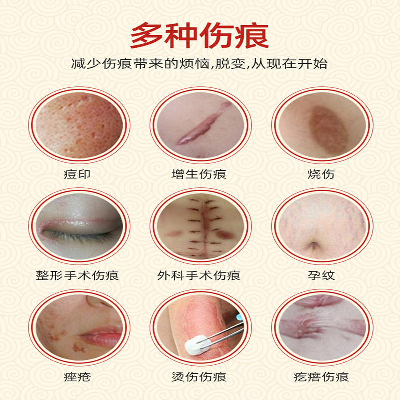 郑州最新胎记去除动态：精准医疗与传统疗法并举