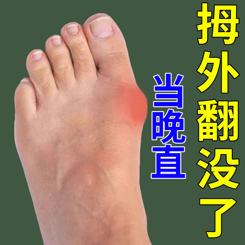 (Rectified 90 thousand people) Thumb Valgus Straightener Orthopus Toe-over Toe Straightener Special Sticker-Taobao