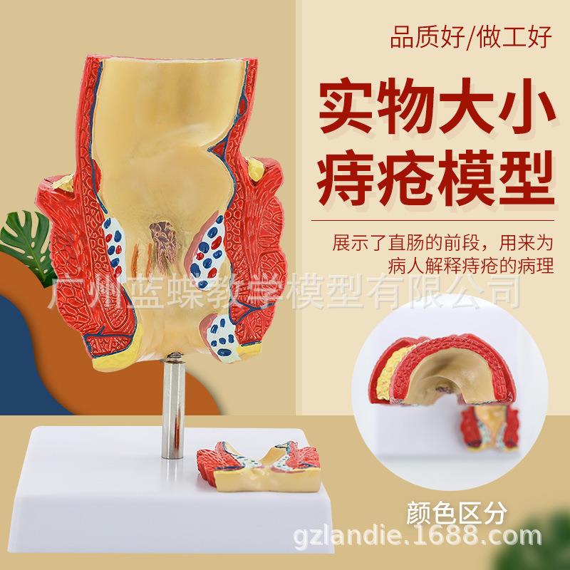 直肠痔疮病变模型 痔疮内外解剖 肛门肛肠科 大肠直肠病理模型