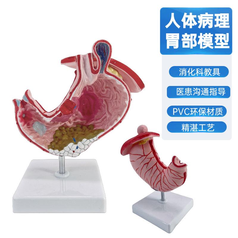 人体胃解剖模型 放大胃结构胃镜教学 病理胃解剖模型 病态胃模型